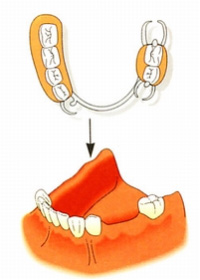 入れ歯のイメージ