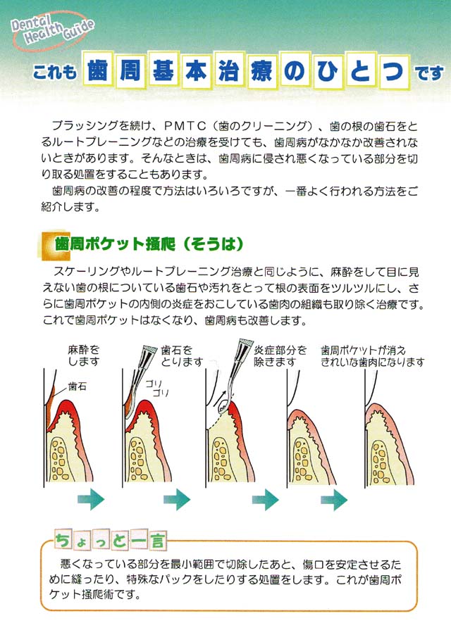 これも歯周基本治療のひとつです