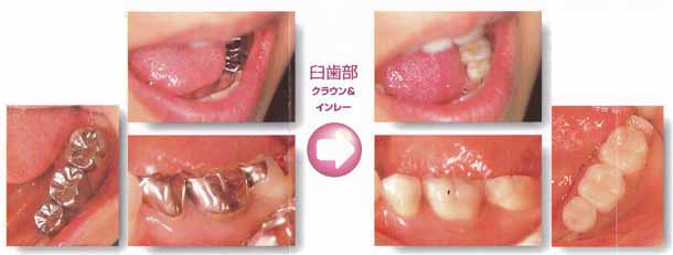 臼歯部クラウン＆インレー