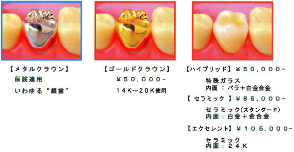 メタルクラウン