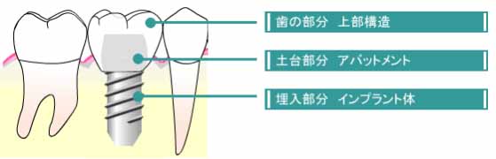 インプラントのイメージ図