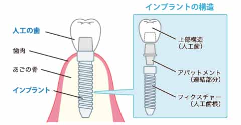 インプラントイメージ図