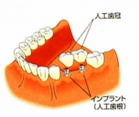 インプラントのイメージ図