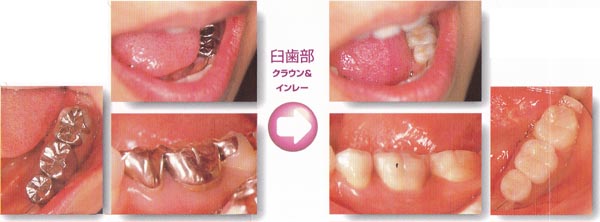 臼歯部クラウン＆インレー