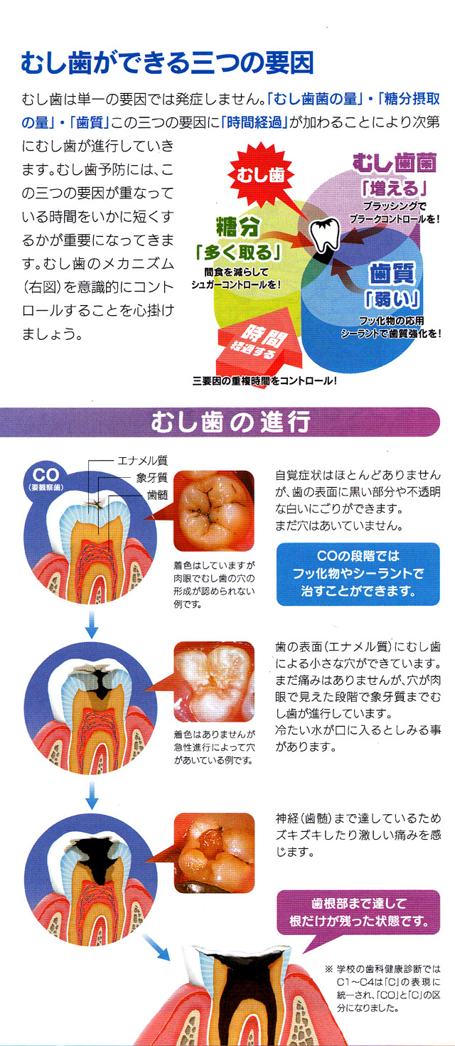 むし歯ができる三つの要因