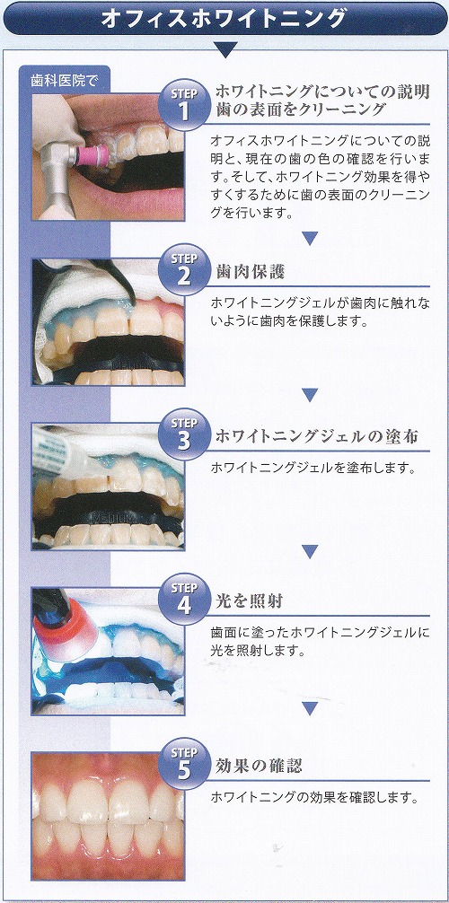 オフィスホワイトニング