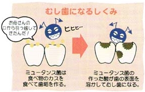 むし歯になるしくみ